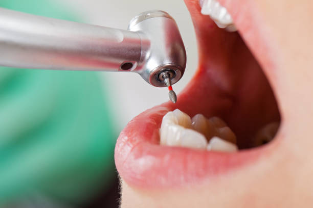 Best Emergency Tooth Extraction in Clanton, AL